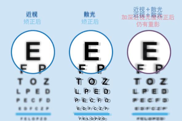 治疗少儿近视的最佳方案,上海少儿近视矫正办法