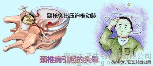 经常头晕要小心是颈椎病？颈椎病的7大缓解方法，很管用！