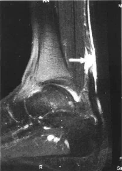 跟腱断裂怎么判断伤残,用什么方法判断跟腱断裂症状