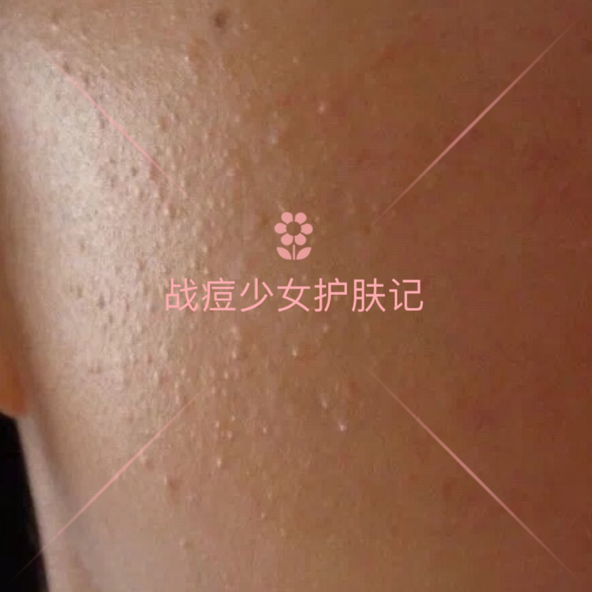 各种类型的痘痘怎么祛痘,痘痘六种类型上集