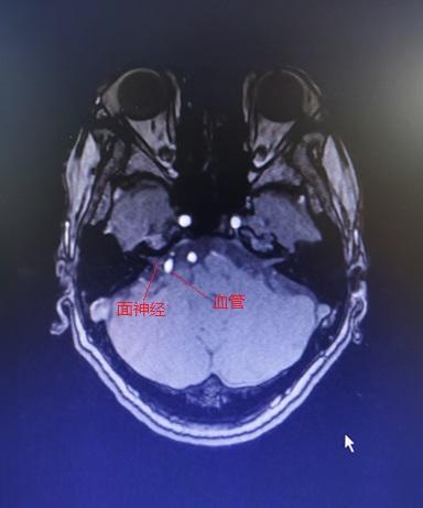 眼皮一直跳是哪里神经出问题了,眼皮总跳眼部神经抽动能放血么
