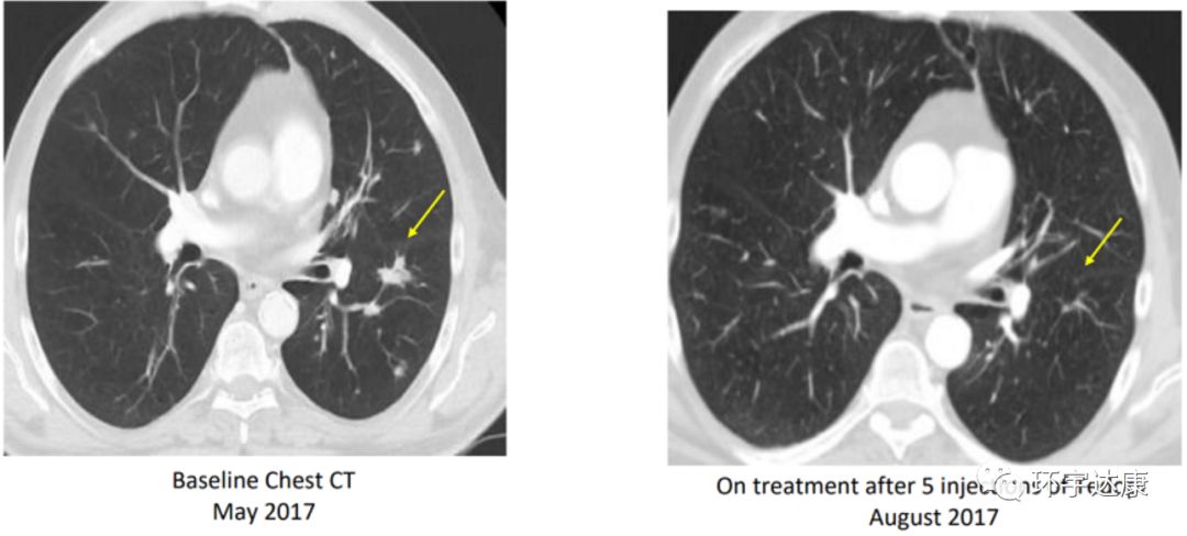 新型癌症疫苗问世对多种癌症有效,现在癌症疫苗都有哪些国家在发