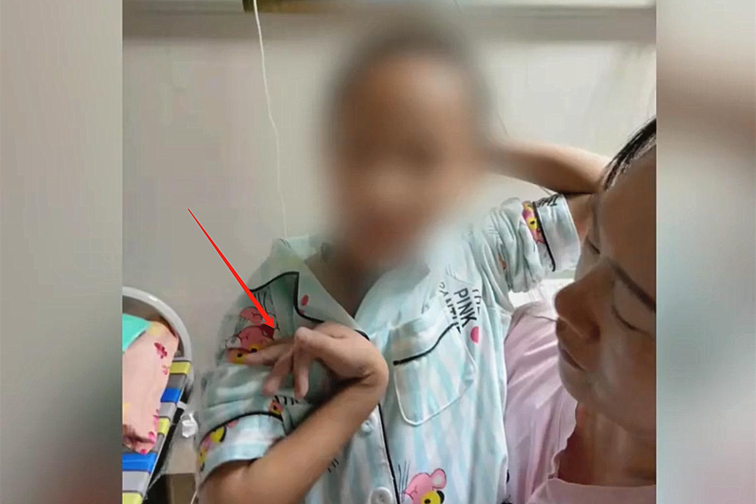 孩子被虫咬了发烧怎么办,小孩被恙虫咬会死吗