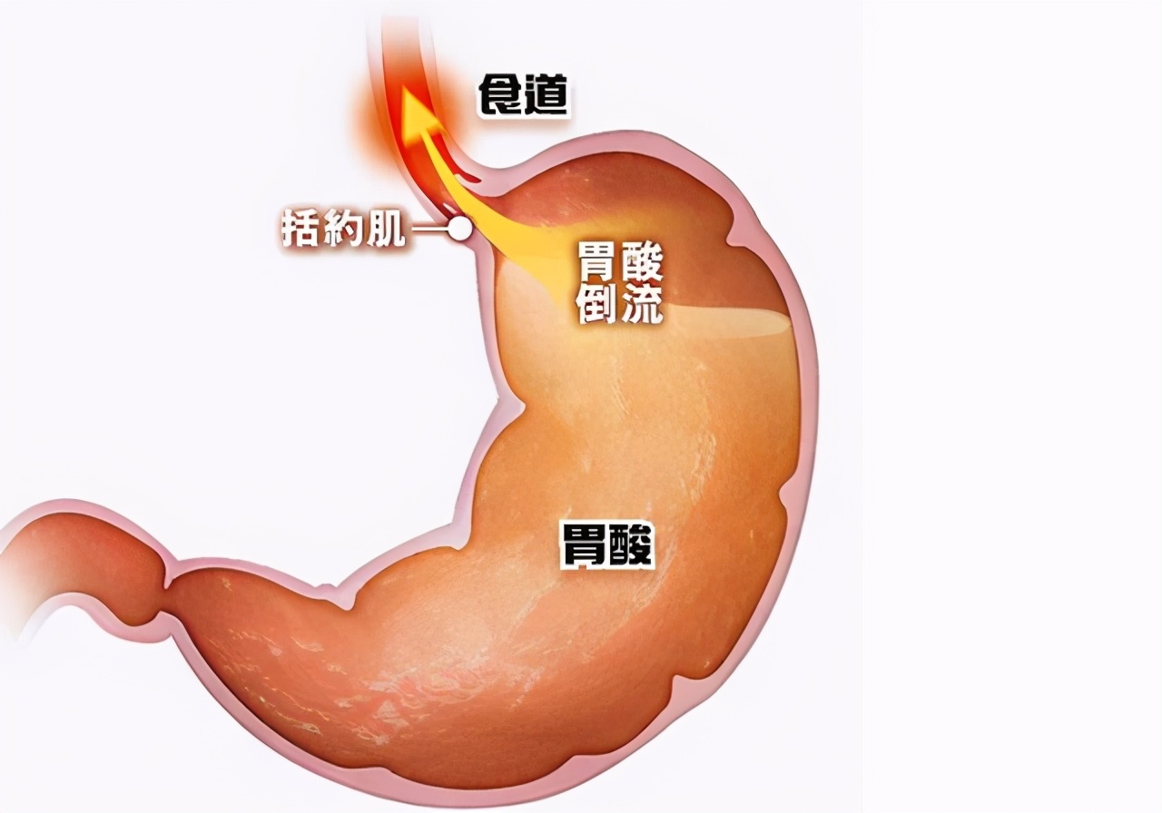 胃酸烧心吃奥美拉唑要吃多久,胃酸烧心吃奥美拉唑管用吗