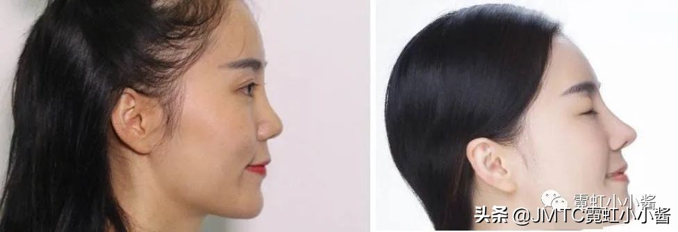 鼻子怎么修复好看呢,鼻型修复方法大全