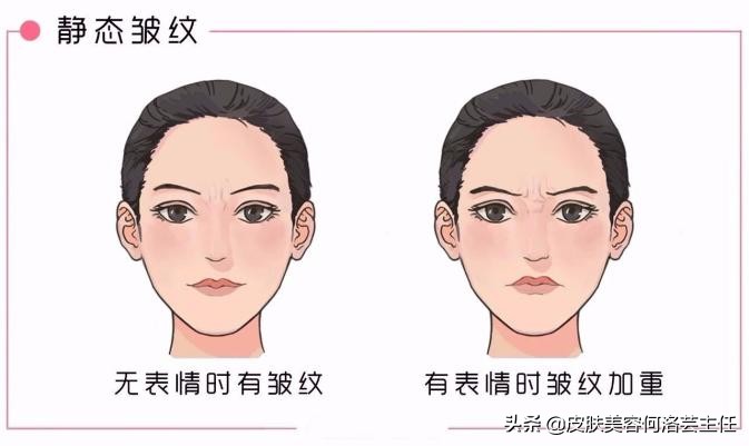 脸上有皱纹的朋友教你一个小诀窍,脸上有皱纹的原因和治疗方法