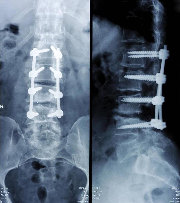 颈椎病脑供血不足的最好治疗方法,椎动脉颈椎病的症状和治疗方法