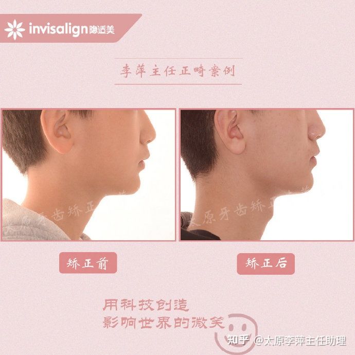 太原牙齿矫正靠谱吗,太原成人隐形牙套牙齿不齐