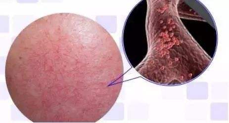 玉泽能修复角质层吗,角质层修复最快方法