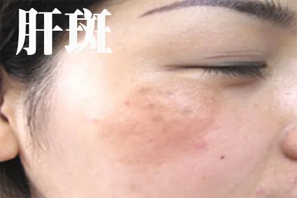 褐斑是怎么引起的,怎么预防长褐斑