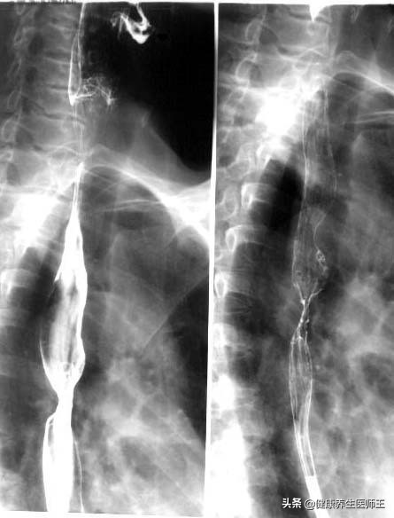 食管癌四期化疗能延长多久生命,食管癌手术后健康宣教