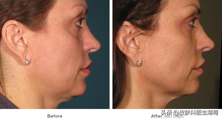 激光点阵祛痘坑收缩毛孔仪器,皮秒激光祛雀斑效果图