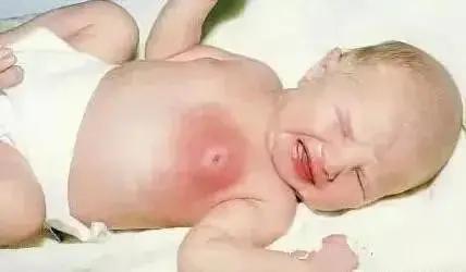 女婴挤乳腺后果,新生女婴被挤乳核了怎么办