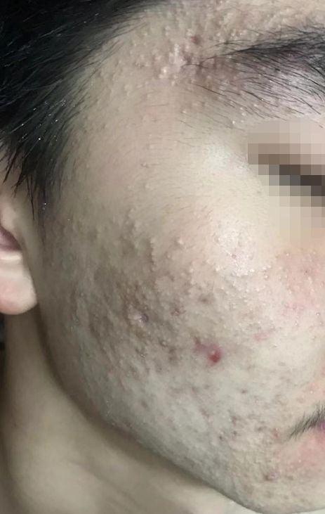 屏障受损起闭口粉刺多长时间能好,不要小看了闭口粉刺