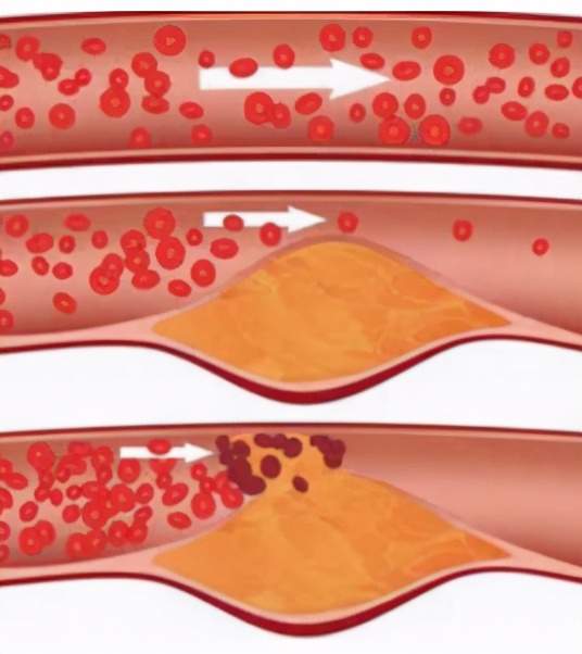 脑动脉硬化严重了会有什么后果,脑动脉硬化一般最好的治疗方法
