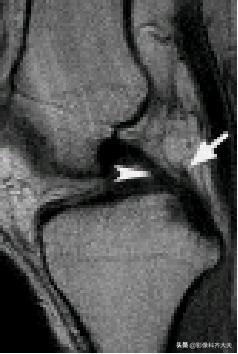膝关节半月板损伤的磁共振,膝关节半月板病变的mri诊断与鉴别