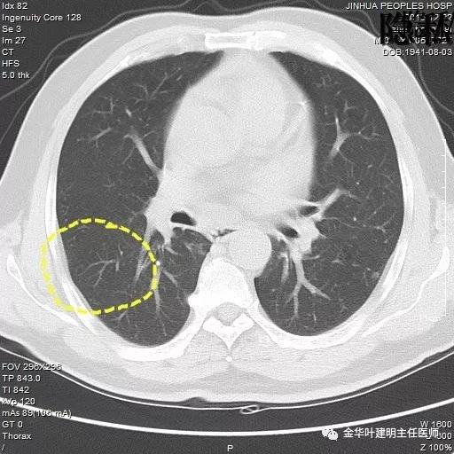 警惕-会是简单的肺大泡吗？