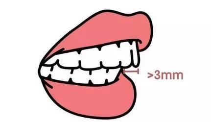 戴牙套凸嘴怎么化妆,凸嘴整牙削骨吗