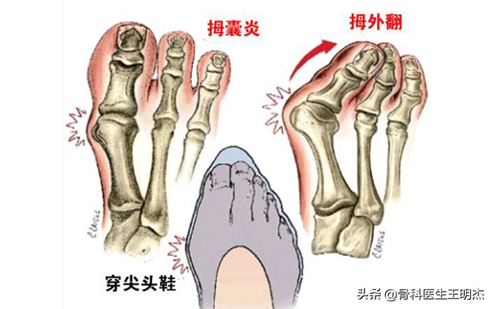高跟鞋踩脚到底有多痛,高跟鞋穿久了脚底痛