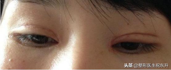 割双眼皮后怎样可以尽快完全恢复,割双眼皮的危害老了以后会怎样