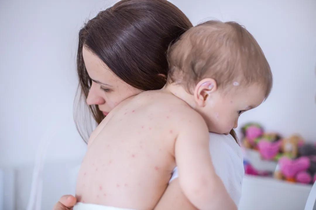 宝宝脸上长了很多小痘痘带有粉刺,宝宝脸上长痤疮留下痘坑