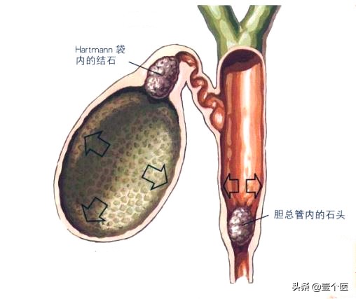 肝胆相照科普,胆囊肝胆相照