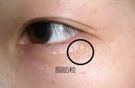 黑眼圈严重是熬夜引起的还是胃寒,突然有黑眼圈眼睛肿是什么原因