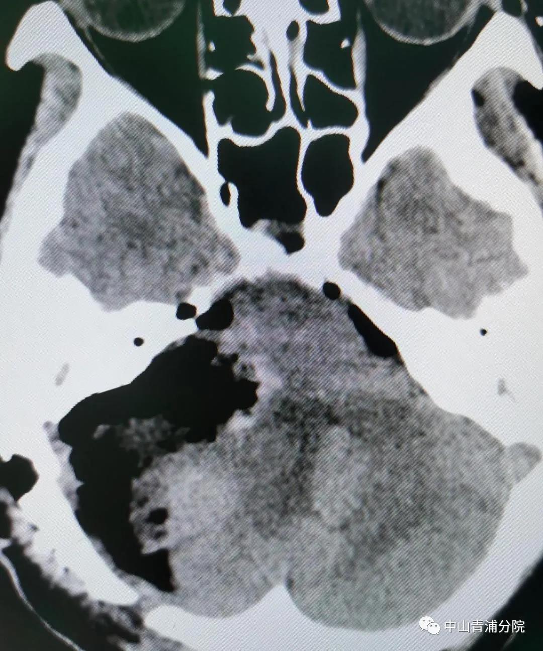 几度风雨人生,听神经瘤患者自述