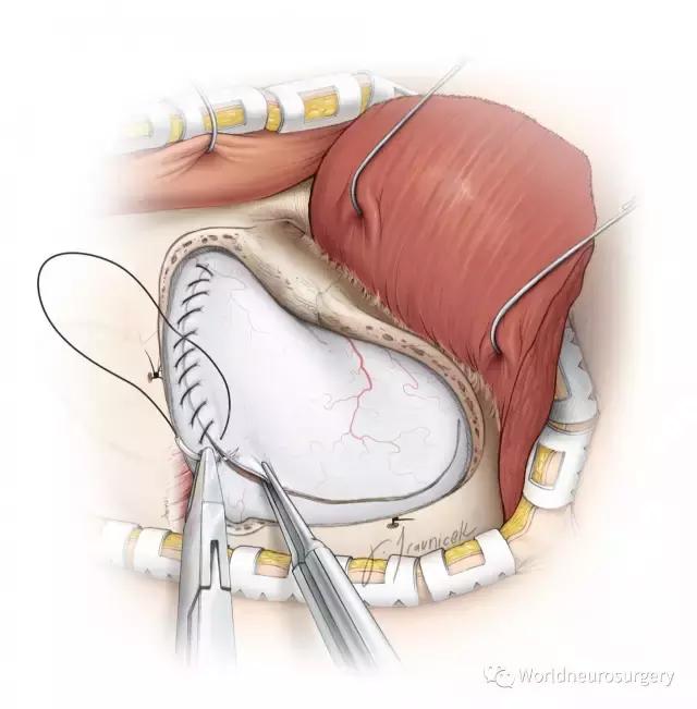 翼点入路的开颅要点,翼点开颅详解图