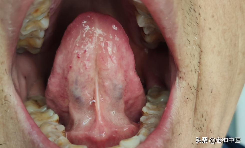 治疗幽门杆菌胃炎的药物有哪些,胃炎幽门螺杆菌感染怎么治疗