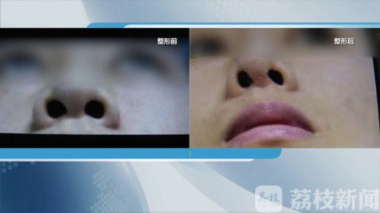 南京施尔美整容失败案例,无锡施尔美隆鼻真实案例