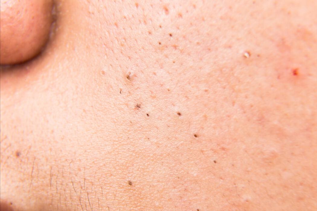 老是长闭口粉刺怎么调理,总是长痘痘粉刺吃什么药