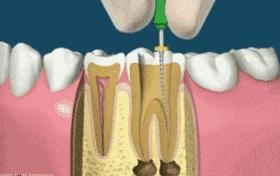 牙齿蛀牙怎么治疗,治疗蛀牙的视频
