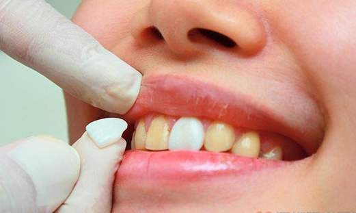 牙齿黄怎么办变白对牙齿无伤害,用什么洗牙齿牙齿会变白