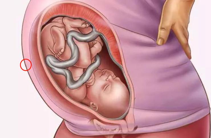 胎宝宝抠妈妈肚皮什么感觉,孕妈抠肚脐会造成胎儿脐绕颈吗