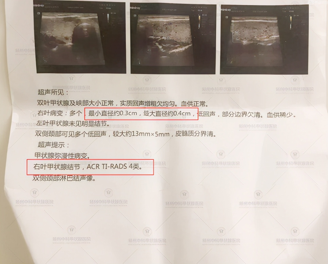 体检发现3毫米结节，医生建议观察。结果半年竟然成癌