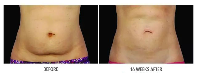 酷塑冷冻溶脂副作用是什么样的,酷塑冷冻溶脂的真实经历对比