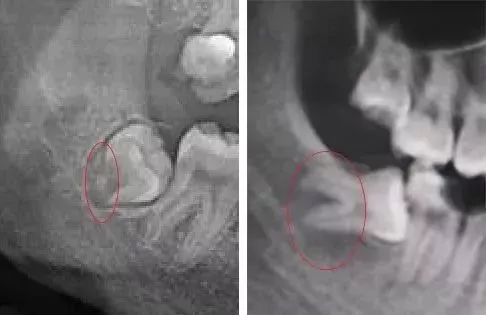 为什么拔智齿那么疼,为什么拔智齿会痛这么久