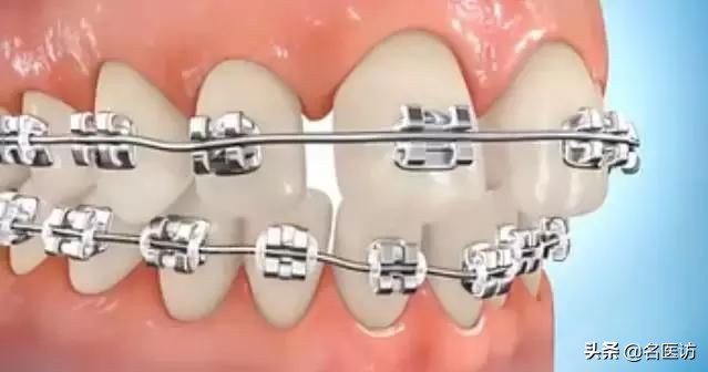 牙齿稀疏牙缝小怎么矫正效果最好,牙缝正畸后有概率还会恢复牙缝吗