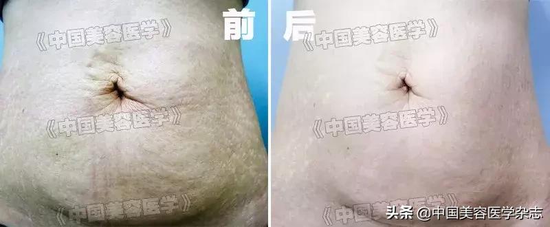 双极多通道射频联合负压治疗仪改善腹部皮肤松弛伴妊娠纹