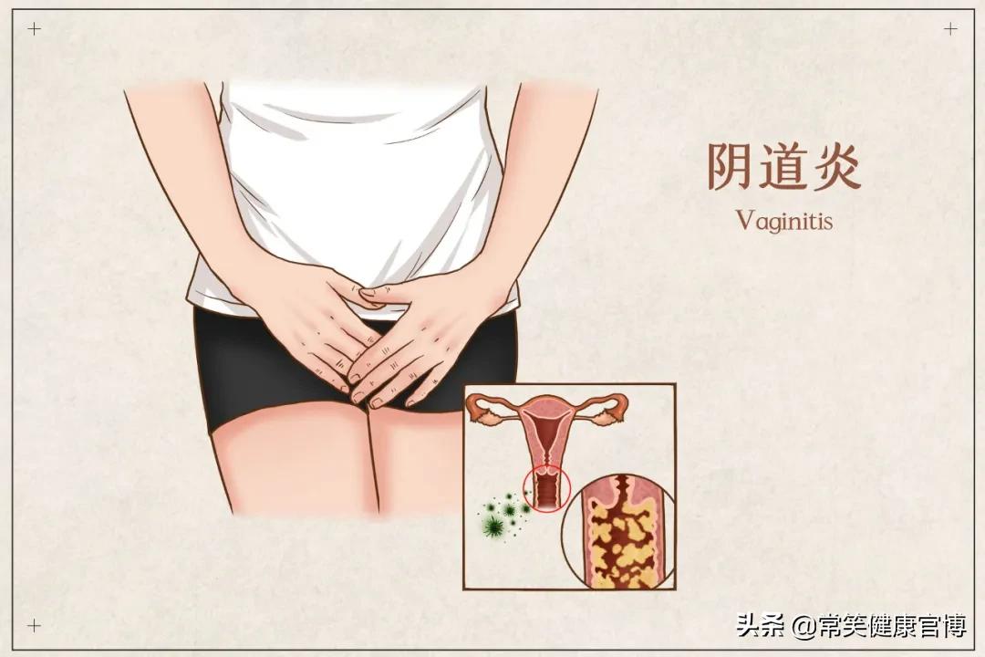 怎么才不容易得宫颈炎,得了宫颈病变丢人吗