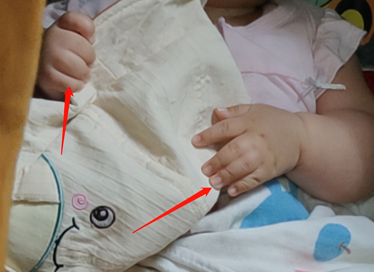 并指畸形免植皮案例,并指畸形