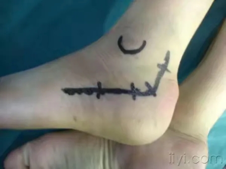 左股骨粗隆间粉碎性骨折微创手术,跟骨粉碎性骨折微创手术最快多久