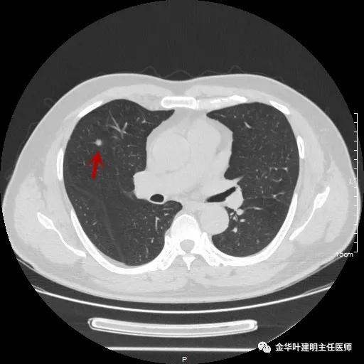 医者仁心过度治疗,肺实性结节多大需手术