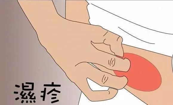 晚上湿疹瘙痒厉害怎么办用什么,孕妇湿疹晚上痒的睡不着怎么办