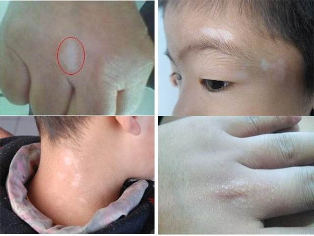 什么原因会导致婴儿得白癜风,孩子出生就有白癜风原因