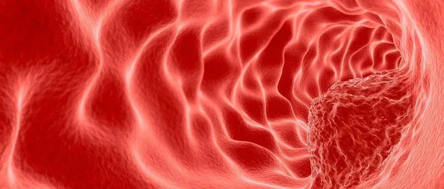 宫颈癌复查哪项能看出复发,宫颈癌随访可以防止复发么