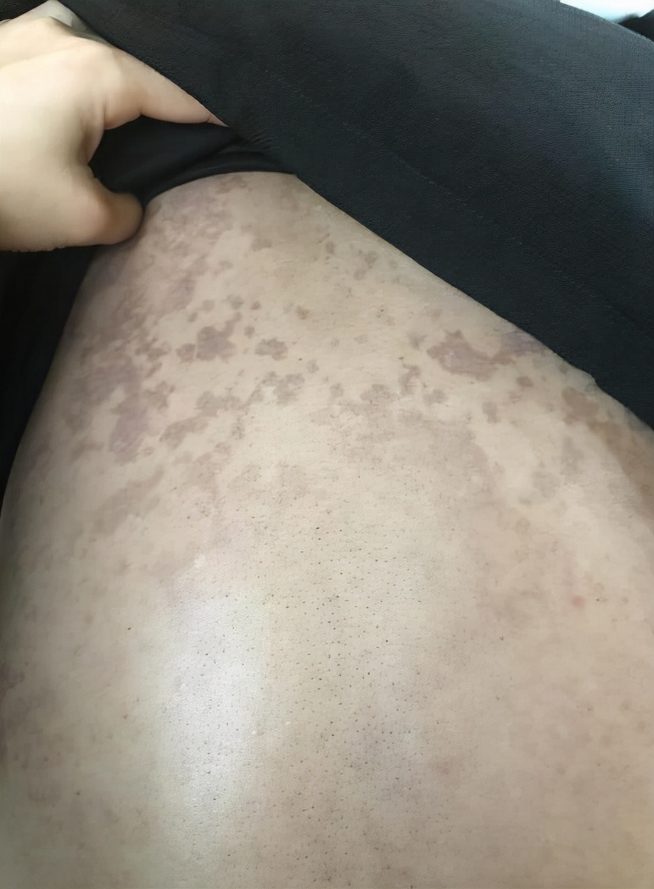 错把艾滋病当皮肤病,别错把艾滋当成皮肤病