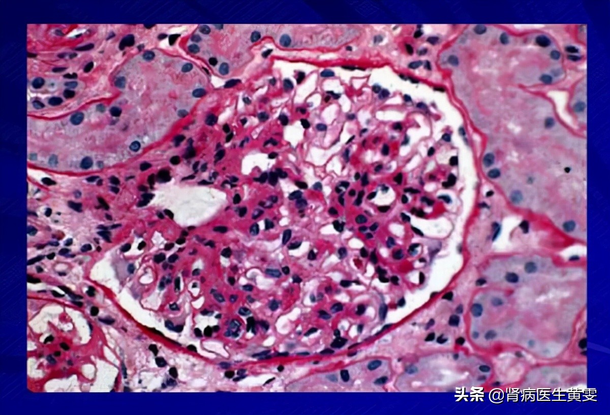 女性得IGA肾炎最初征兆,31岁女性得了IgA肾病怎样治疗