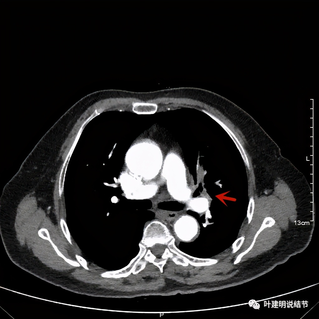 卡瑞利珠单抗治疗肺鳞癌有用吗,特瑞普利单抗对鳞癌治疗有效吗